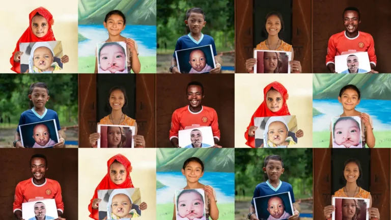 Children holding before-and-after photos of cleft surgery supported by Smile Train